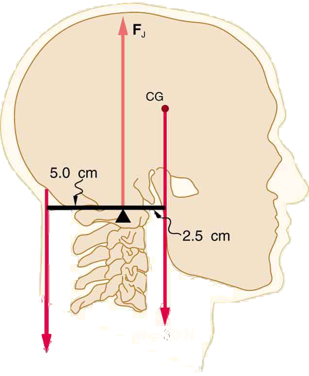 An erect head is shown. The weight of the head is fifty newtons. The center of gravity of the head lies in front of its support. The perpendicular distance between the support and the weight of the head is two point five centimeters. Between these forces, there is a point where a vertical force vector is shown. This force is marked as F sub J. At the back of the head, five point zero centimeters behind the support point, is a downward vector labeled F sub m.