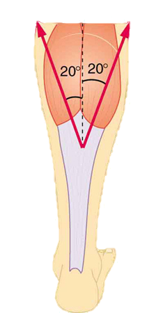 An Achilles tendon is shown in the figure with two forces acting upward, one at an angle of plus twenty degrees, one at minus twenty degrees. F sub one, equal to two hundred newtons, is shown by a vector making an angle twenty degrees toward the right with the vertical, and F sub two, equal to two hundred newtons, is shown making an angle of twenty degrees left from the vertical.