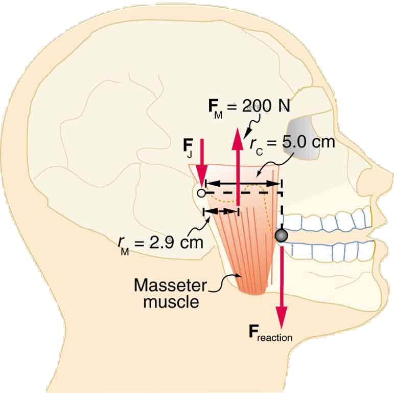 The masseter muscles of a jaw of a man are shown. The force F sub M is equal to two hundred newtons and is acting on the muscle in upward direction and the force F sub J is acting to the left end of the muscle downward. The span of the muscle at upper part is five centimeters. At the joint of jaw, the reaction force is downward.