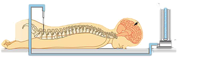 Diagram of a person lying face-down on a table hooked up to a medical apparatus. A needle attached to a tube is inserted between the patient’s vertebrae in the lower back area. The tube, which appears to be filled with fluid, is connected to an upright tube containing an unknown amount of water. The height of the water in the tube is labeled question-mark centimeters H 2 O. A label pointing to the patient’s head reads P equals ten millimeters H g.