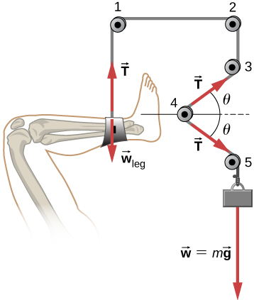 Figure shows a leg on the left. It is attached to a rope at the ankle and suspended from a pulley at the top. The rope continues to a second pulley on the right of the first, a third one to the bottom of the second, a fourth one to the bottom left of the third and a fifth one to the bottom right of the fourth. An object with weight w = mg is attached at the end of the rope. An arrow labeled w subscript leg points downwards from the ankle and an arrow labeled T points upwards from there. An arrow labeled T, from the fourth pulley to the third, forms an angle theta with the horizontal. Another arrow labeled T, from the fourth pulley to the fifth forms an angle minus theta with the horizontal.