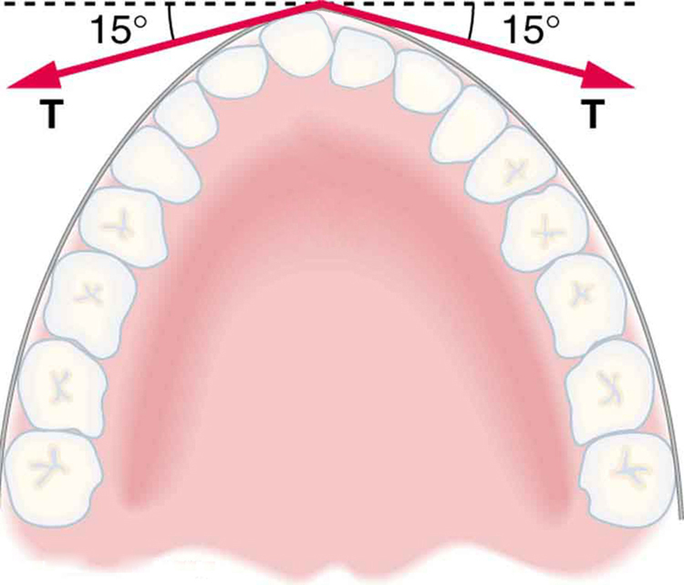 Cross-section of jaw with sixteen teeth is shown. Braces are along the outside of the teeth. Three forces are acting on the protruding tooth. A force, T, is shown by an arrow making an angle of fifteen degrees below the positive x axis, and a second force, T, is shown by an arrow making an angle of fifteen degrees below the negative x axis.